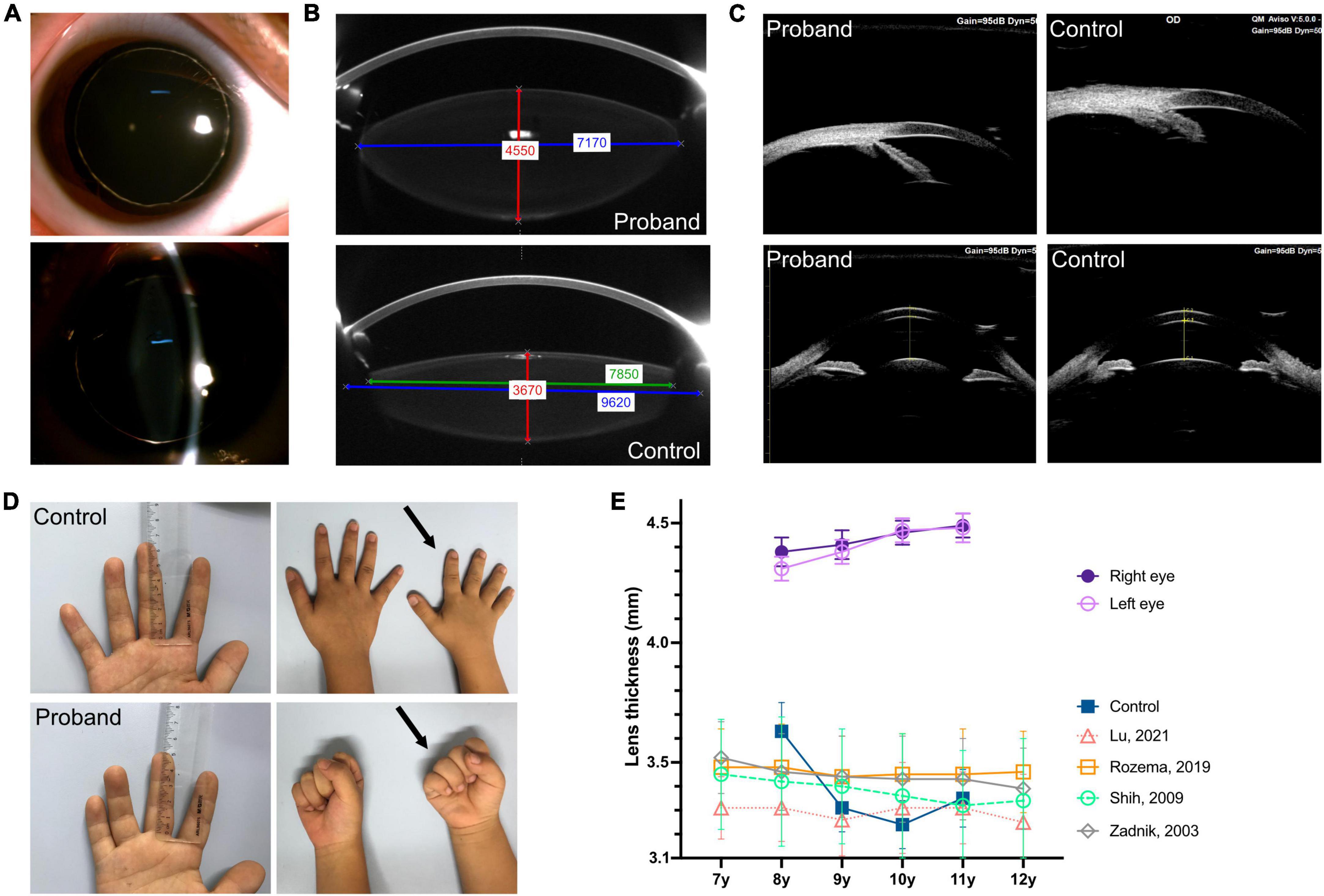 Abnormal lens thickening in a child with Weill–Marchesani syndrome 4: A 3-year follow-up case report